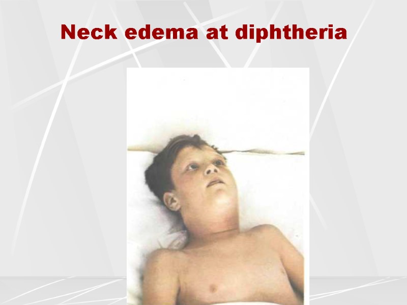 Neck edema at diphtheria